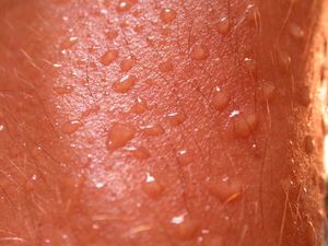 zonal displacement of sweating - compensatory sweating
