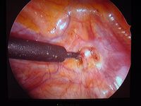 endoscopic transthoracic sympathectomy