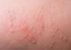 allergic skin irritation