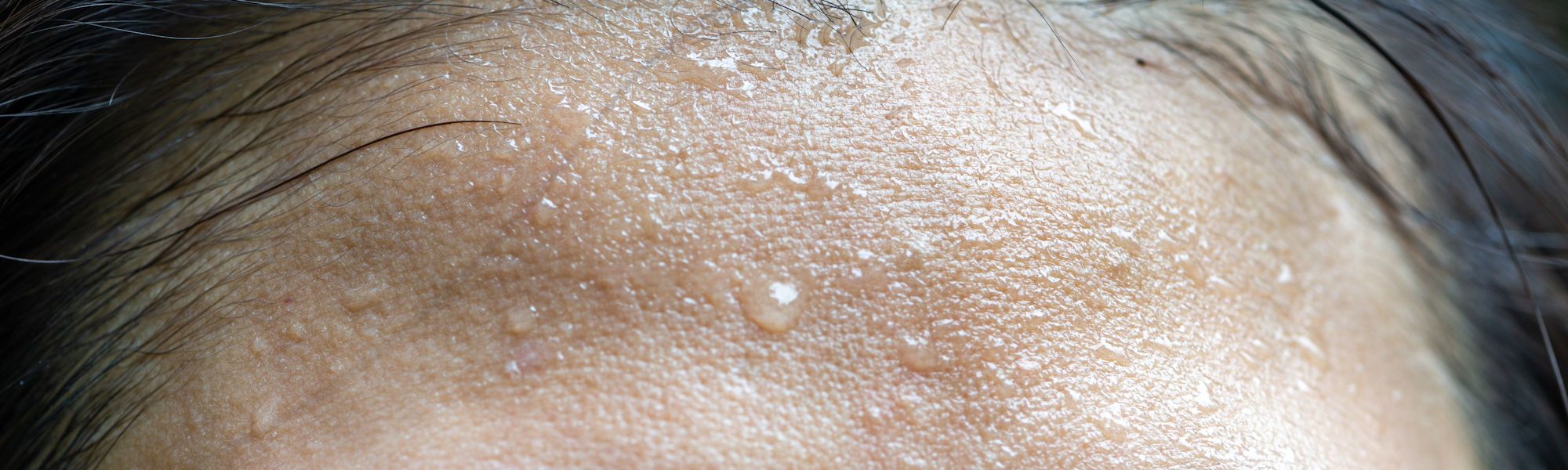 Hyperhidrosis facialis - excessive sweating in the facial area