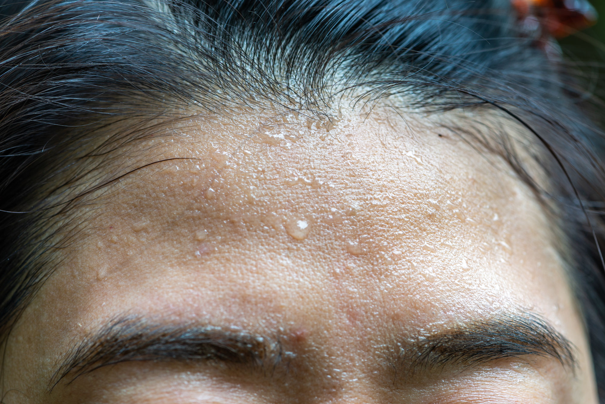 Hyperhidrosis facialis - excessive sweating in the facial area
